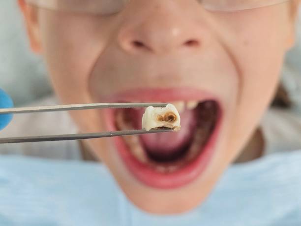 Best Emergency Root Canal Treatment in Georgetown, GA